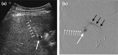 (a) Transabdominal ultrasound image shows a pseudoaneurysm (large white ...