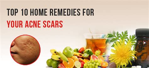 Top 10 Home Remedies for Acne Scars | How to remove Acne from face ...