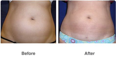 Liposuction VASER Ultrasound Laser Corona CA