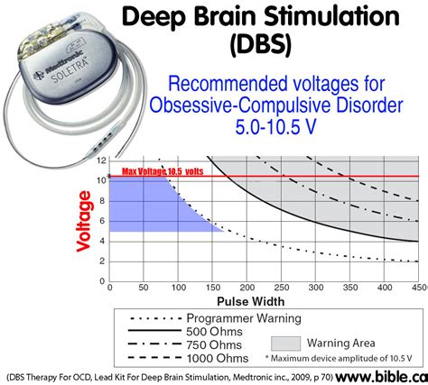 Deep Brain Stimulationdbs Mental Illness Obsessive Compulsive Disorder Ocd Brain Treatments