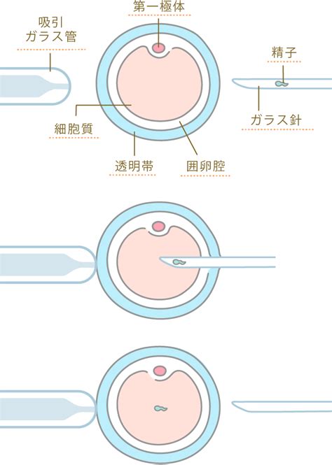 【体外受精 Ivf 】顕微授精 Icsi について 高度不妊治療のにしたんartクリニック