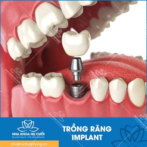 TÌM HIỂU VỀ QUY TRÌNH CẤY GHÉP IMPLANT CHUẨN NHA KHOA