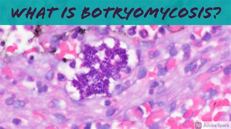 What is Botryomycosis? Hint: it's not fungus! 5-Minute Pathology Pearls Dermatology Dermpath ...