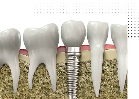 Dental Implants In Pune Dental Implants Near Me Shivaji Nagar