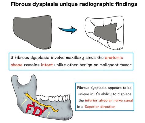 Fibrous Dysplasia Radiology Dental Notes Medinaz Blog