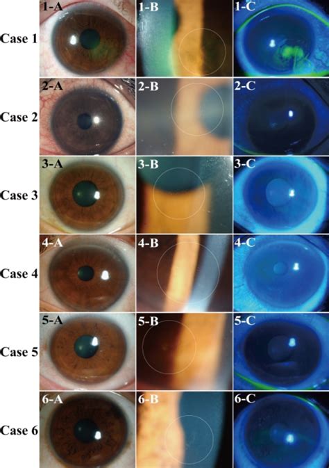 Slit Lamp Biomicroscopic Findings Of The Six Cases Of T Open I