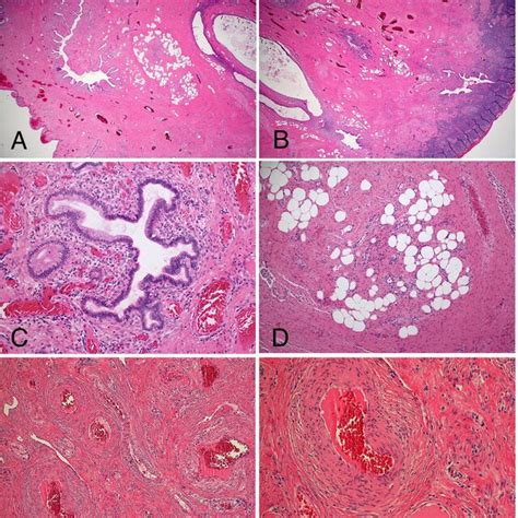 Endocervical Polyp With Abnormal Thick Walled Vessels And Heterologous