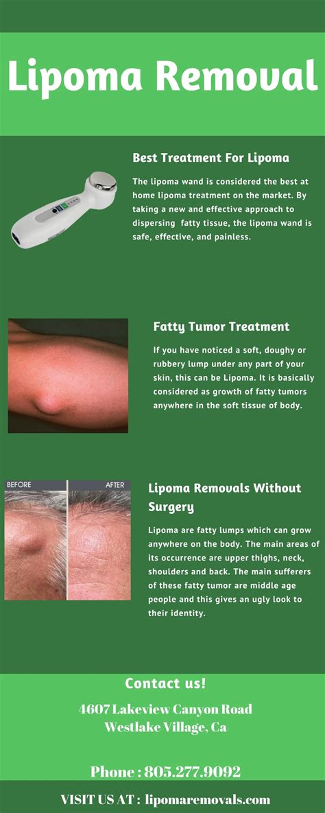 Ppt Lipoma Removal Lipoma Wand Powerpoint Presentation Free