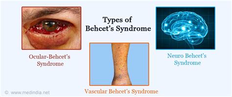 Behcet’s Disease - Its Symptoms, Causes And Types