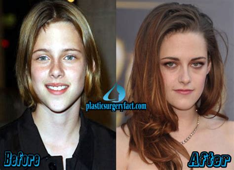 Kristen Stewart Plastic Surgery Before And After