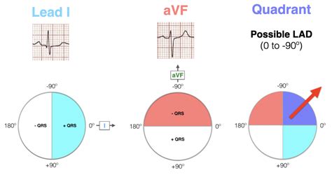 Ecg Axis Interpretation • Litfl • Ecg Library Basics