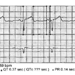 Baseline EKG Demonstrating A Normal Sinus Rhythm Without Bundle Branch