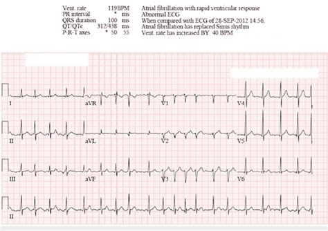 Initial Ecg Obtained In The Emergency Department Demonstrating Atrial Download Scientific