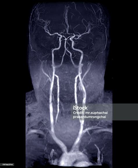 Mra Angiografía Cerebral Y De Cuello O Resonancia Magnética De La