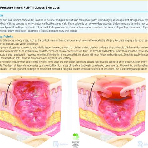 Difference Between Pressure Ulcers And Moisture Lesions Download Table | Images and Photos finder