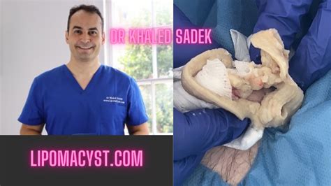 Massive Abdominal Cyst Dr Khaled Sadek Lipomacyst Youtube