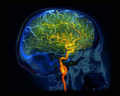 Primary Central Nervous System Vasculitis From Diagnosis To Management Neurology Advisor