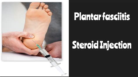 Plantar Fasciitis Steroids Injection Youtube