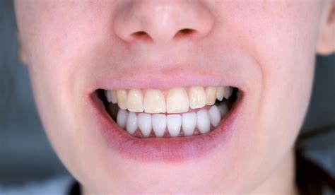 Why Our Teeth Turn Yellow And What To Do About It