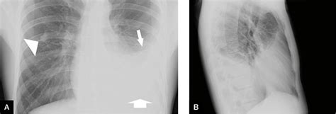 Racgp An Uncommon Cause For A Unilateral Pleural Effusion Rheumatoid Pleuritis