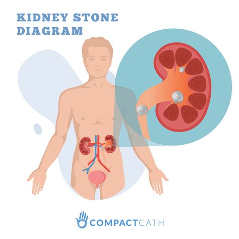 Kidney Stone Pain Cartoon / For more information visit iuhealth.org ...