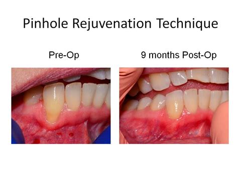 Dr Robert L Franklin Jr Pinhole Technique Pst Before And Afters