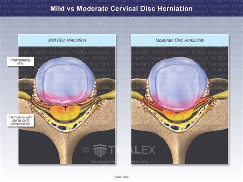 Mild Vs Moderate Cervical Disc Herniation Trial Exhibits Inc