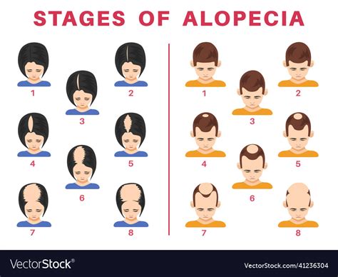 Stages Of Alopecia In Men And Women Set Royalty Free Vector