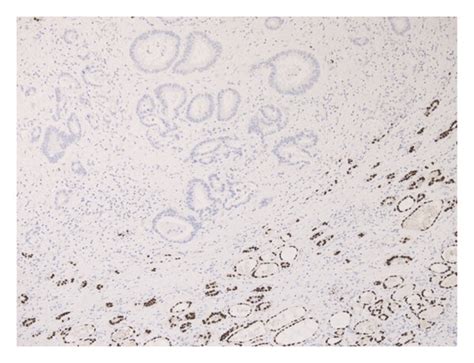 Pathologic Examination Of The Excised Mass Hematoxylin And Eosin