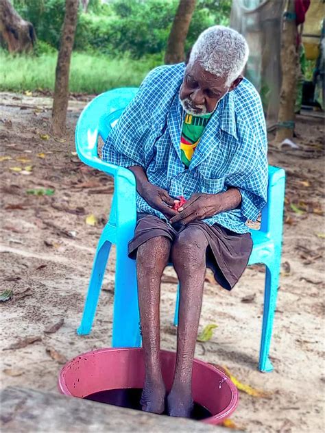 The Fight to Eliminate Jiggers Disease - In Pictures