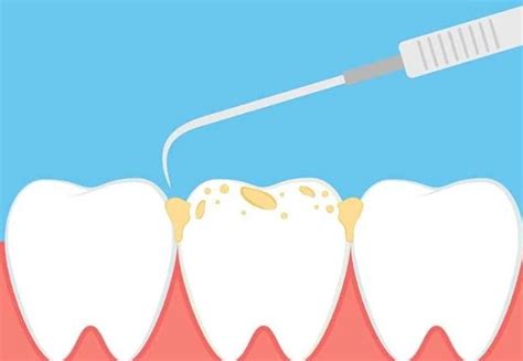 Diş Taşı Oluşumunu Engellemenin 3 Etkili Yolu Like Smile Turkey