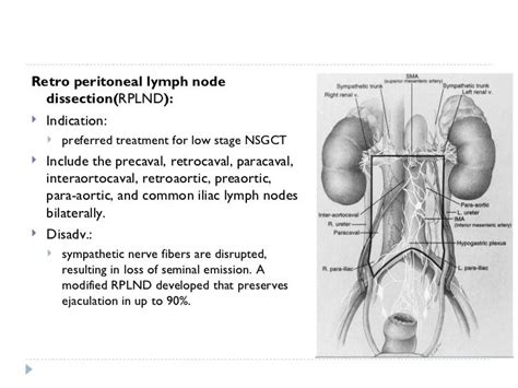 Part 1 Management Of Testicular Carcinoma Dr Vandana