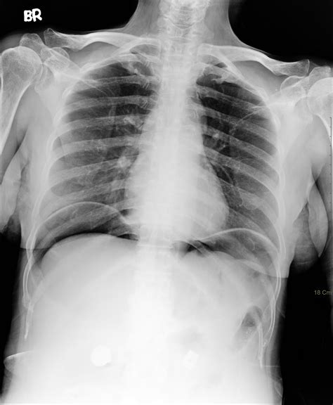 Pneumoperitoneum Wikipedia 55 Off