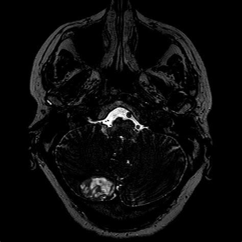 Dysplastic Cerebellar Gangliocytoma Image Radiopaedia Org