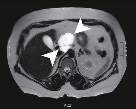 Figure 1 From Pancreatic Cystic Lymphangioma Case Report And