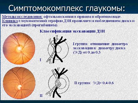 Патология офтальмотонуса. Глаукома - online presentation
