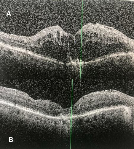 Full Article Pars Plana Vitrectomy With Internal Limiting Membrane Peeling For Treatment Naïve