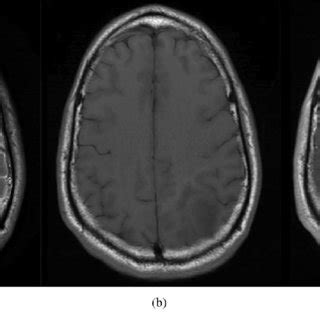 Case 3 MRI Brain On Initial Presenting A T2 Axial B T1 Axial C T1