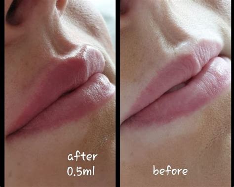 Lip Filler Before And After Photos And Results The Daily Glimmer