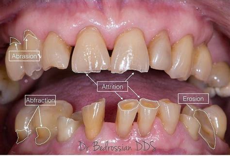 الفرق بين الاستنزاف الأسنان، Abfraction والتعرية والتآكل Dental Decay