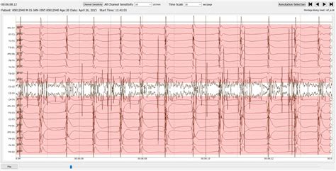 Temple University Eeg Corpus Example0007