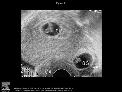 Hysteroscopic Management Of Heterotopic Cesarean Scar Pregnancy Ppt