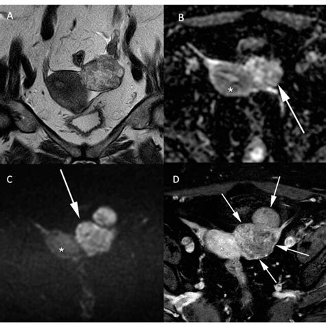 Histologically Proven Left Ovary Adenocarcinoma In A 64 Year Old Woman