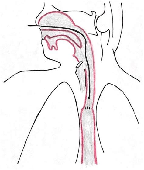 Probe placement esophageal pH-metry. | Download Scientific Diagram