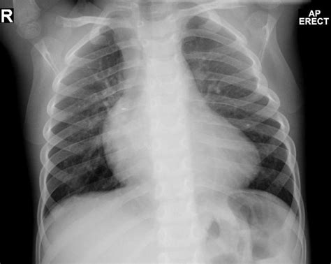 Right ventricular outflow tract obstruction chest x ray - wikidoc