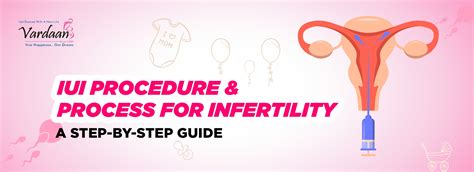 Iui Procedure Process For Infertility A Step By Step Guide