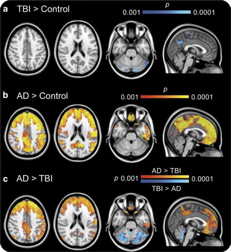 C Pib Pet Imaging In Ad And Tbi Patients The Image Presents The