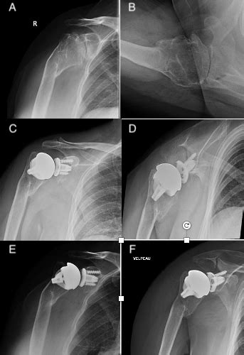 Stemless Shoulder Arthroplasty For Glenohumeral Arthritis With