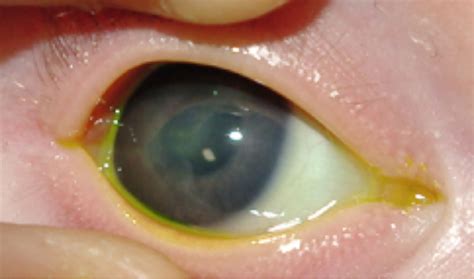 Herpes Simplex Ophthalmia Neonatorum A Sight Threatening Diagnosis