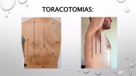 Toracocentesis Y Toracotomia Ppt